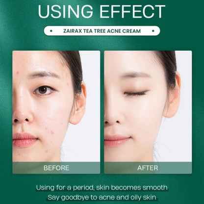 Tea Tree Acne Control Cream