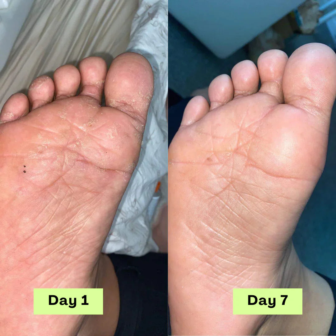 Zairax® AntiFungal Relief Soap Bar