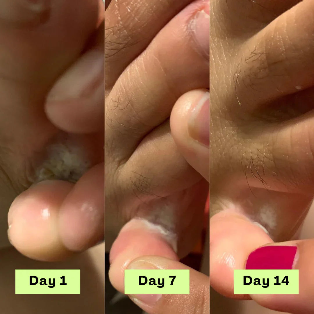 Zairax® AntiFungal Relief Soap Bar